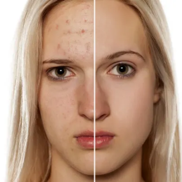 Acnes & Blemishes